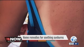 Best home remedies for sunburn [upl. by Giaimo559]