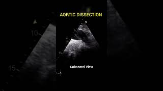 Aortic Dissection with freeflow between True and False Lumen echocardiography [upl. by Adian998]