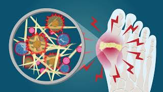 Gout What you need to know [upl. by Rather]