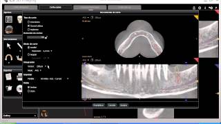 Tutorial CS 3D imaging software 16Carestream Imprimir mas de 25 cortesavi [upl. by Dunton]