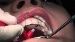 Composite Fillings [upl. by Wivinah134]