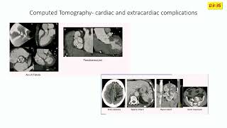 ESC GUIDELINE UPDATE ON INFECTIVE ENDOCARDITIS – Dr Vikash Agrawal [upl. by On]