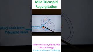 Mild Tricuspid Regurgitation [upl. by Zetta776]