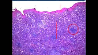 Sarcoidosis Rhino Actinomycosis Leprosy FB 2024  jars and slides [upl. by Ecydnak2]