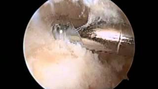 Posterior Ankle Arthroscopy with Os Trigonum Debridement SFISM [upl. by Adroj262]