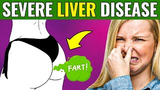 17 SIGNS that your LIVER is DYING  DANGEROUS [upl. by Cia474]