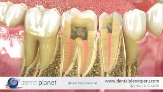 Endodoncia en una sola cita  DENTAL PLANET PERÃš [upl. by Einon]