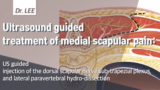 TrailerUltrasound guided intervention of the medial scapular pain US  anatomy and technique [upl. by Ennovehc]