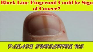 Black Line Fingernail Could be Sign of Cancer V 4 YOU [upl. by Junette]