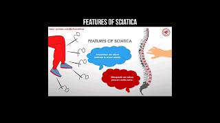 Features of sciatica backpain sciaticapain sciatica sciaticnervepain [upl. by Kristoforo875]