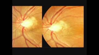 Optic Pit Maculopathy Managment [upl. by Deutsch]