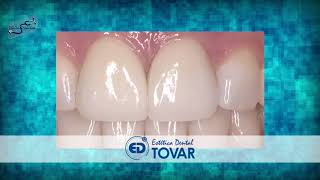 Clínica Dental Tovar  Usos del Zirconio en la Odontología [upl. by Gnauq]