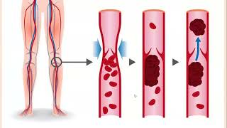 Lecture193 Varicose Veins DVT Superficial thrombophlebitis amp Venous Insufficiency Rook Ch 103 [upl. by Seek]