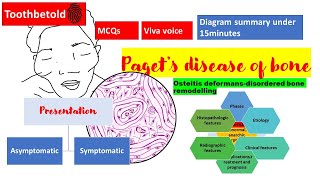 Pagets disease of bone  RadiographHISTOPATHOLOGYclinical features  NBDENEET MDSBDS  Diagrams [upl. by Wilmar594]