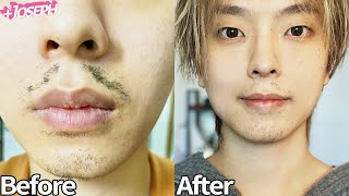 레이저제모 후 근황 10년 넘게 고생하던 거 한방에 해결했습니다 Self Laser Hair Removal Face At Home [upl. by Nivanod]