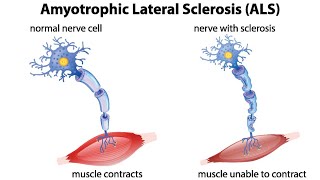 Amyotrophic Lateral Sclerosis ALS Nervous System Disease  Medical Surgical Nursing [upl. by Adnalahs]