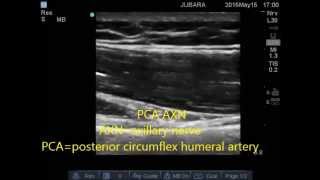 axillary nerve sonoanatomy [upl. by Timmie]