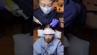 Platelet Mesotherapy aka PRP or platelet rich plasma treatment for hair loss with Kryzz UY [upl. by Lana]