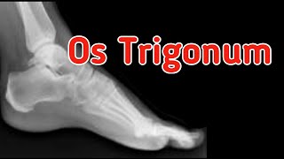 Os Trigonum and Os Trigonum Syndrome [upl. by Erl]