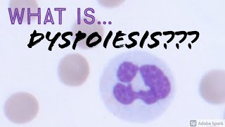 What is Dyspoiesis on peripheral blood smear A short explanation Hemepath amp Hematology [upl. by Phina]