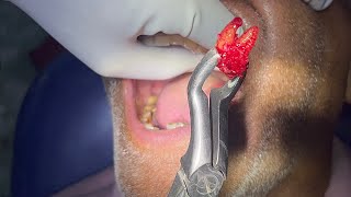 Maxillary second molar extraction dentist dentistry oralsurgery youtube trending [upl. by Ethban304]