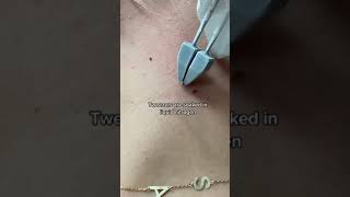 Doctors shows painless way to get rid of skin tags in the clinic  208SkinDoc [upl. by Laeno85]