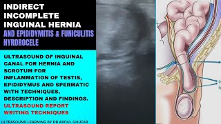 Inguinal hernia ultrasound  hernia signs and symptoms  inguinal hernia report  hernia ultrasound [upl. by Christis]