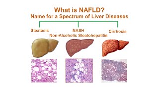 What is NonAlcoholic Fatty Liver Disease NAFLD [upl. by Lledyr]