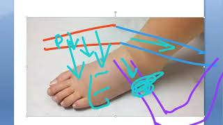 Obstetrics 131 Edema in Pregnancy Causes physiological pathological swollen leg ankle face Anasarca [upl. by Harwin]