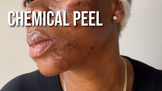 PCA Chemical Peel on Black Skin for Hyperpigmentation and Texture [upl. by Aslehc116]