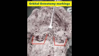 Facial Bipartition Surgery for Ocular Hypertelorism Correction at GSR Hospital Hyderabad India [upl. by Aicala]