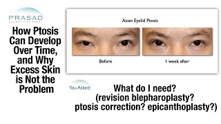 How Ptosis Drooping Eyelid can Develop Over Time and after Previous Double Eyelid Surgery [upl. by Getraer52]