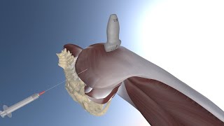 3D Model of Ultrasound Guided Greater Trochanteric Bursitis Injection by probeultrasound [upl. by Colman307]