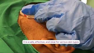 Microneedling Radio Frequency Treatment for Acne  Skin Clinic in Sarjapur Road  SK Truderma [upl. by Remas]