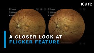 A Closer Look at Flicker Feature  iCare Retinal Imaging [upl. by Kauffmann]