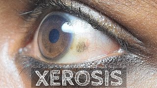 Xerophthalmia  Vitamin A deficiency Part 10 [upl. by Notlef]