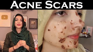 Remove Acne Scars گڑھے Get Smooth Even Skin with Easy Home Remedy [upl. by Asselim]