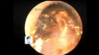 Ear wax removing Cerumen plugs cleaning in children，13 mins [upl. by Cornia]