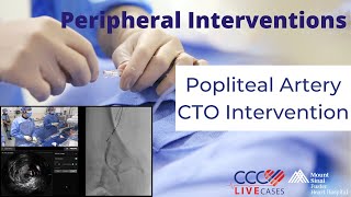 Watch Live Popliteal Artery CTO Intervention [upl. by Ahseiat785]