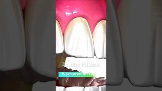 Bone Grafting Explained in Hindi 🤔  Frame Fusion [upl. by Nnylarac]