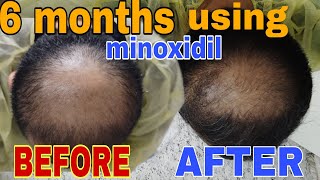 SIX MONTHS USING MINOXIDIL Regaine for men UPDATE minoxidil highlights SerARTvlog [upl. by Sikleb]