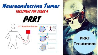 PRRT Treatment Neuroendocrine Tumors [upl. by Akeihsat]