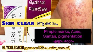 How to use glycolic Acid creamGlyco 6ww Review in malayalam [upl. by Hildie182]