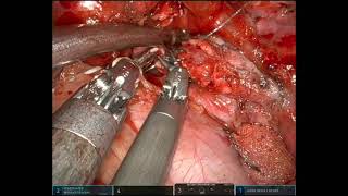 URATS left main bronchus sleeve resection and second carinal reconstruction for carcinoid tumor [upl. by Elorak]