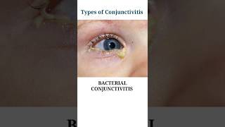 Types of Conjunctivitis pink eyes eyecareoptom pinkeye redness eyeinfection shorts short [upl. by Ahsa374]