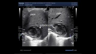 Ultrasound Video showing Hepatic hydatid cyst [upl. by Orly]