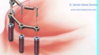 implantes dentales explicacion facil de entender  vídeo para pacientes [upl. by Htebazila782]