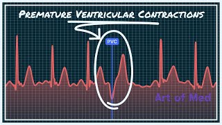 Premature Ventricular Contrcations Ventricular Bigeminy Trigeminy Quadrigeminy [upl. by Nanyk]