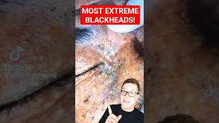 Shocking BLACKHEAD REMOVAL  Extreme Blackhead Extraction shorts [upl. by Bloom]