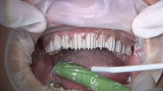 Chairside Live Episode 233 Placing Veneers in the Anterior [upl. by Marsiella315]